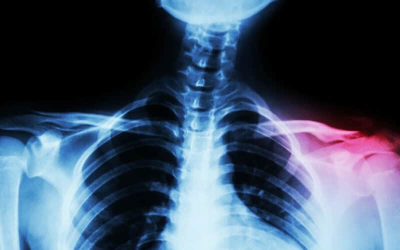 Film x-ray both clavicle AP ( front view ) : show fracture distal left clavicle